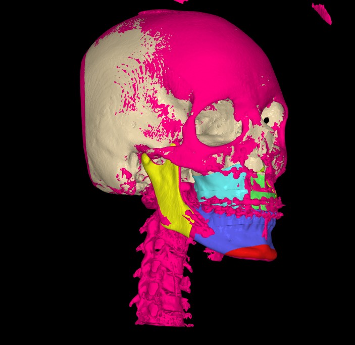 3D planning superimposition
