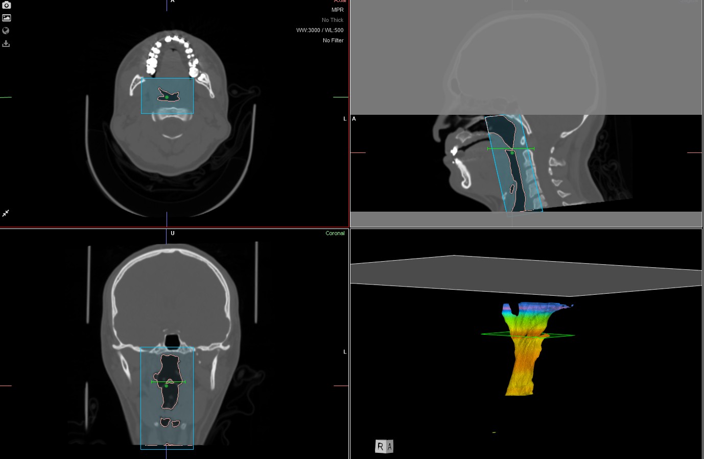 Airway analysis