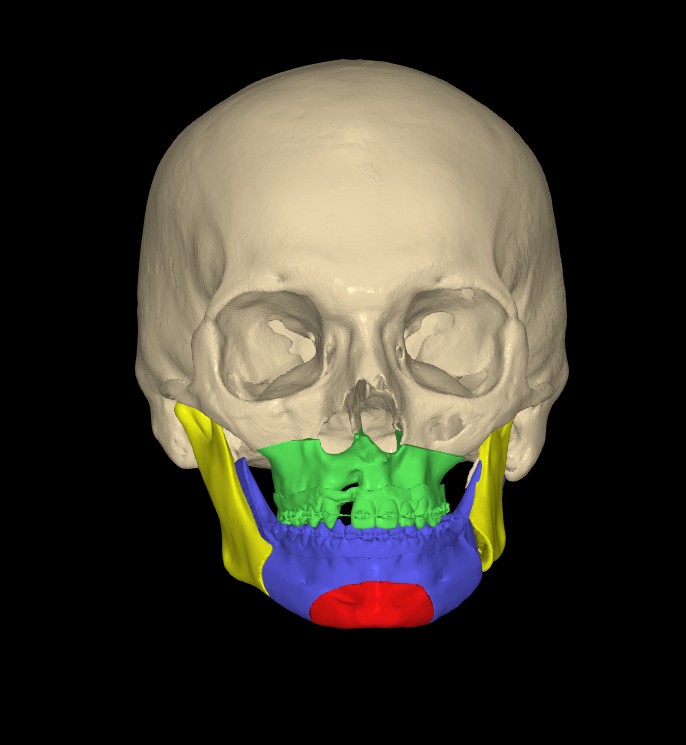 Double-jaw cleft planning