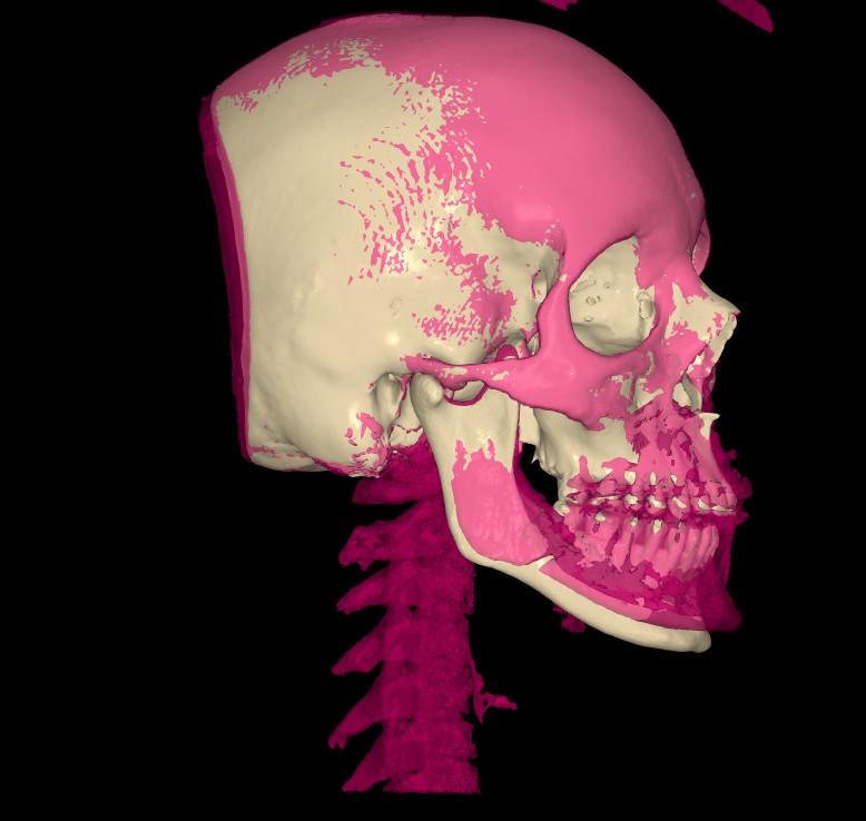 Pre/post superimposition